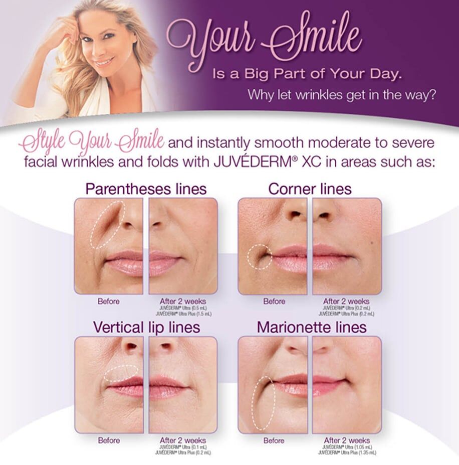 Juvederm Salt Lake City UT | Juvederm XC Salt Lake City | Dermal Fillers, image size:916x927